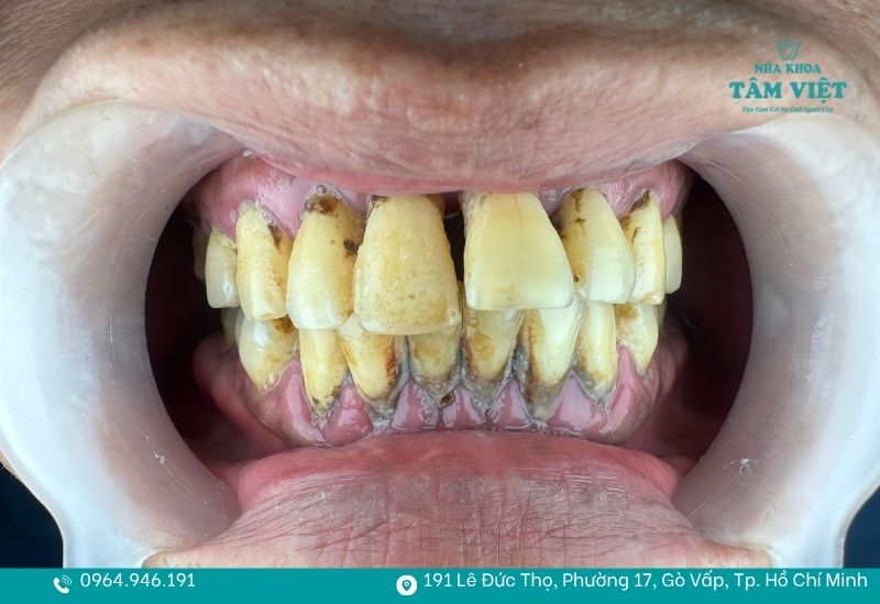 Tình trạng răng miệng ban đầu cũng ảnh hưởng đến việc nhai khi mới bọc răng sứ