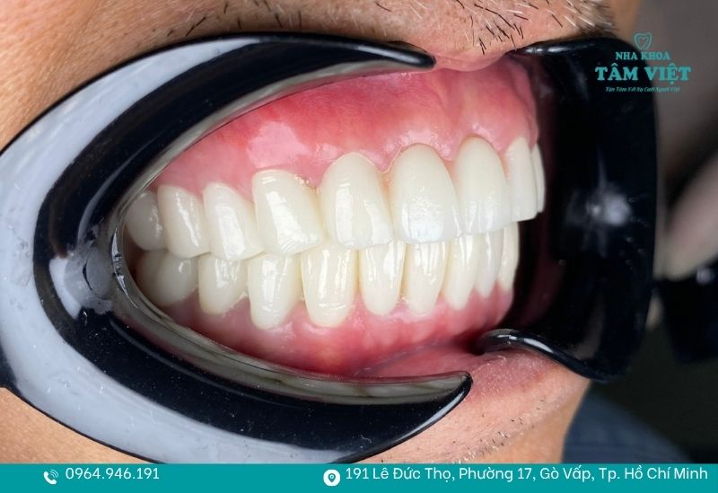 Nếu tình trạng khó chịu kéo dài, bạn nên đến nha khoa để kiểm tra sớm