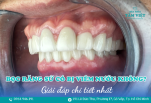 bọc răng sứ có bị viêm nướu không