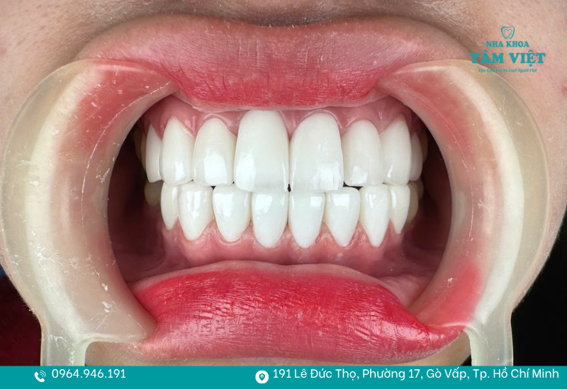 Có nhiều nguyên nhân dẫn đến bọc răng sứ có bị viêm nướu không

