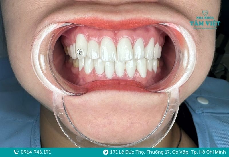 Các dòng răng sứ cao cấp đều có khả năng chống bám màu tốt 