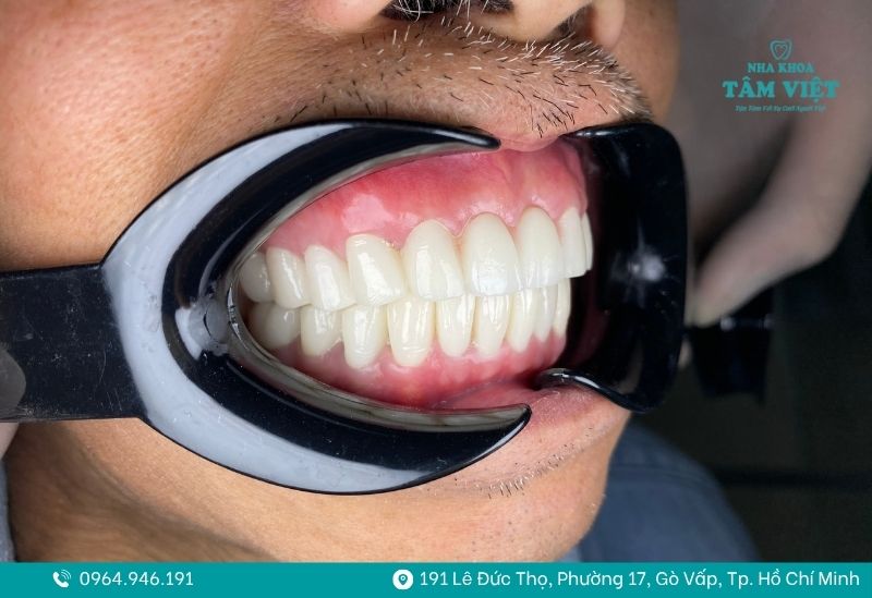 Răng sứ có bị xuống màu hay không còn phụ thuộc vào nhiều yếu tố 