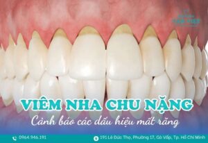 dấu hiệu viêm nha chu nặng