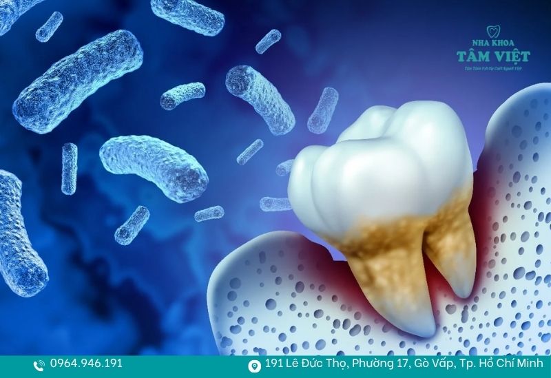 Vi khuẩn sẽ tấn công sâu xuống các tổ chức quanh răng