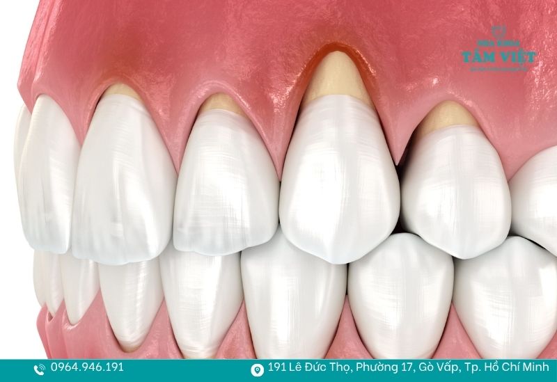 Tụt lợi nghiêm trọng, răng trông dài ra