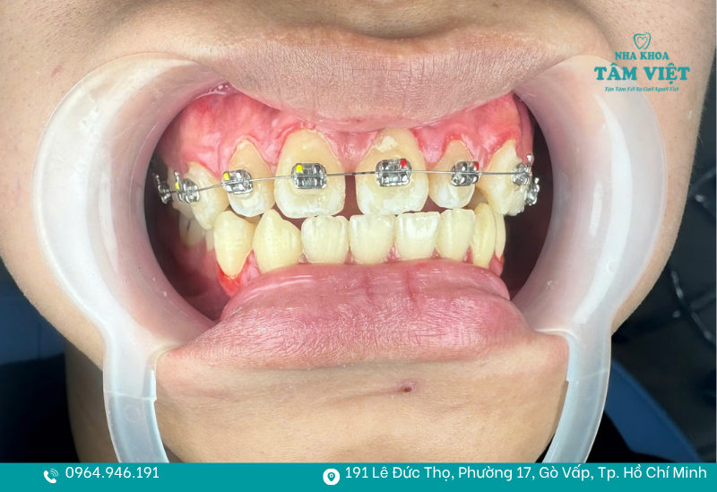 Niềng răng liên quan trực tiếp đến khớp cắn và khả năng ăn nhai
