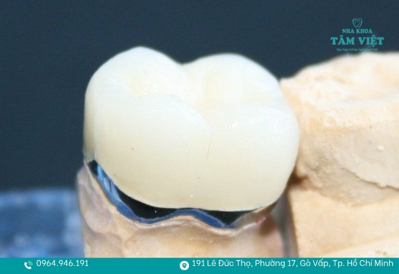 Răng sứ kim loại