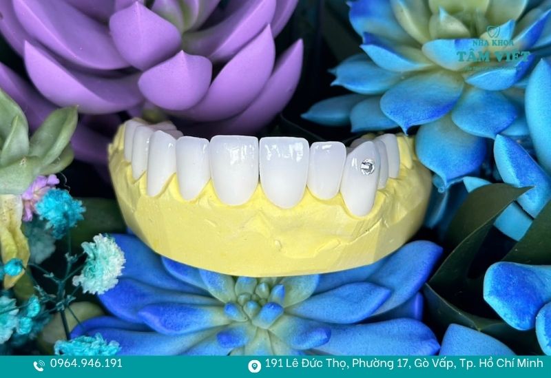 Răng sứ có tuổi thọ trung bình từ 8 đến 10 năm