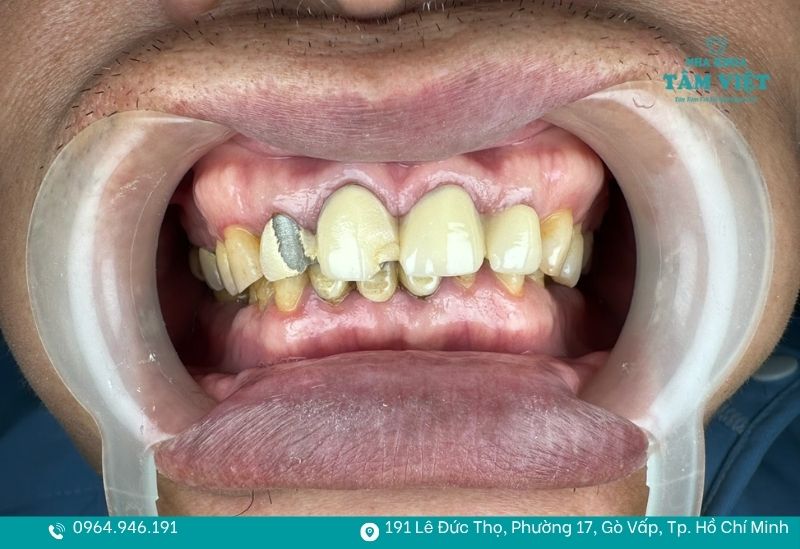 Răng sứ nứt vỡ là dấu hiệu dễ nhận biết giúp bạn biết khi nào cần thay răng sứ mới