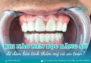 khi nào nên bọc răng sứ