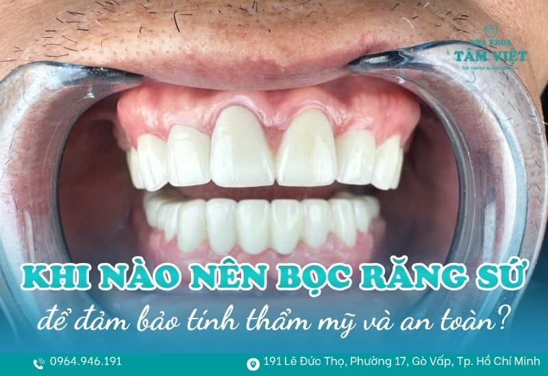 Khi nào nên bọc răng sứ để đảm bảo tính thẩm mỹ và an toàn? 1 khi nào nên bọc răng sứ