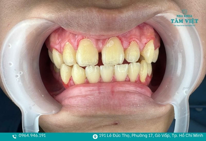 Khi nào nên bọc răng sứ để đảm bảo tính thẩm mỹ và an toàn? 3 Răng thưa và thể hình không đẹp