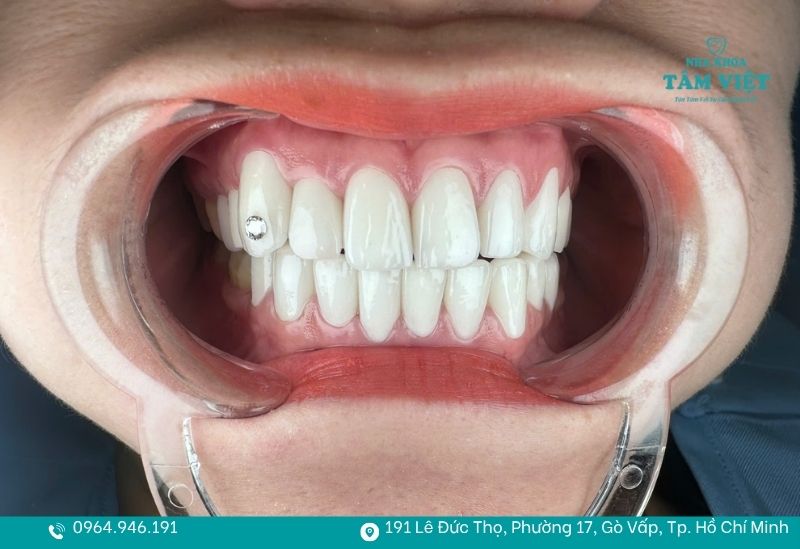 Khi nào nên bọc răng sứ để đảm bảo tính thẩm mỹ và an toàn? 5 Khách đã dùng răng sứ CERCON HT