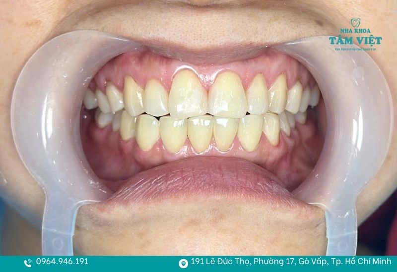 Khi nào nên bọc răng sứ để đảm bảo tính thẩm mỹ và an toàn? 6 Khách dán sứ veneer siêu mỏng