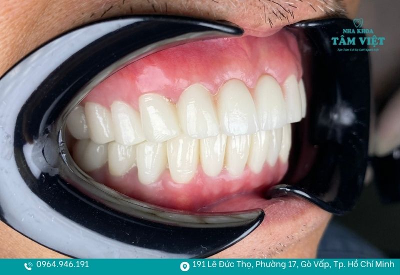 Làm răng sứ ở đâu đẹp TPHCM? Gợi ý địa chỉ uy tín 5 Răng toàn sứ cao cấp được rất nhiều khách hàng lựa chọn