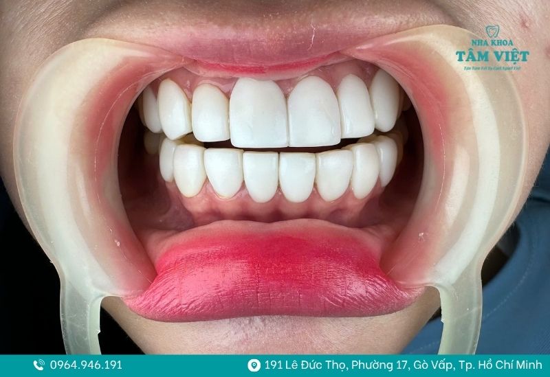 Các dòng răng sứ cao cấp có tính thẩm mỹ cao và bền