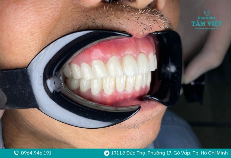 Dán sứ veneer phù hợp cho những trường hợp răng khỏe