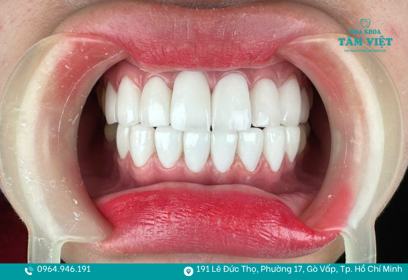 Nha khoa bọc sứ đẹp TPHCM giúp bạn tự tin hơn khi giao tiếp