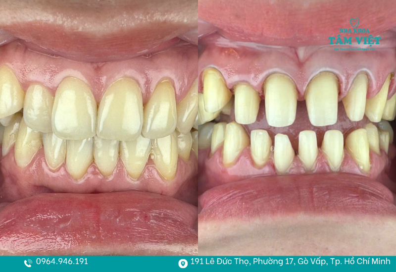 Không mài răng quá nhiều để tránh ảnh hưởng đến cấu trúc răng thật