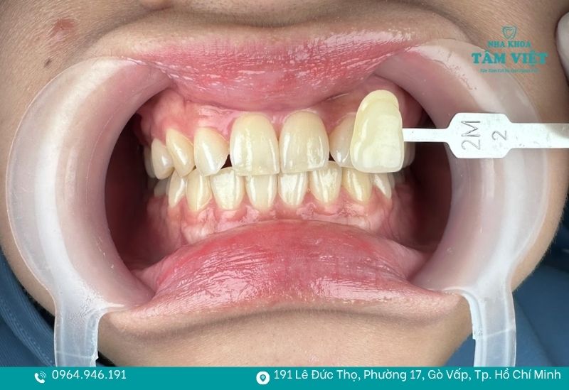 Khách sẽ được làm sạch răng để tiến hành quá trình tiếp theo