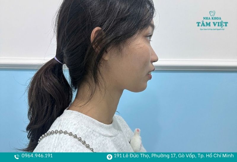 Niềng răng bao nhiêu tuổi là tốt nhất để đạt hiệu quả cao? 2 Độ tuổi từ 12 - 16 được xem là thời điểm lý tưởng để niềng răng