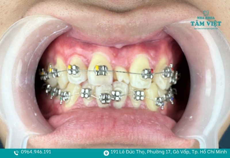 Niềng răng bao nhiêu tuổi là tốt nhất để đạt hiệu quả cao? 3 Niềng răng để cải thiện thẩm mỹ