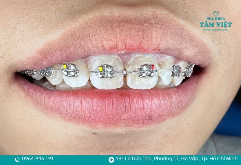 Niềng răng bao nhiêu tuổi là tốt nhất để đạt hiệu quả cao? 4 Bạn nên đi khám sớm để được bác sĩ tư vấn chi tiết