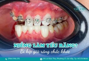 niềng răng có làm yếu răng không