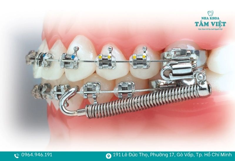 Niềng răng có làm yếu răng không? Bí kíp giữ răng chắc khỏe 4 Cảm thấy răng yếu đi là do lực kéo từ khí cụ quá mạnh