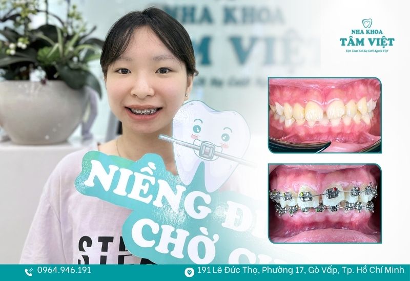 Niềng răng có làm yếu răng không? Bí kíp giữ răng chắc khỏe 6 Niềng răng an toàn tại TPHCM cùng Nha khoa Tâm Việt