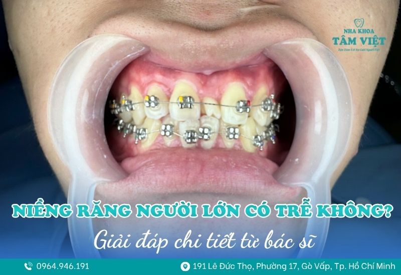 niềng răng người lớn có trễ không