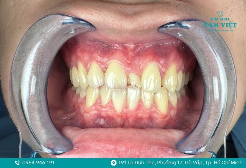 Niềng răng hoàn toàn có thể thực hiện ở nhiều độ tuổi khác nhau 