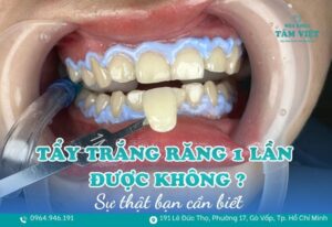 tẩy trắng răng 1 lần được không