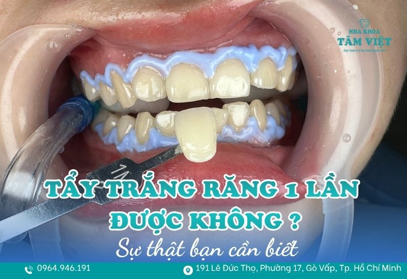 Tẩy trắng răng 1 lần được không? Sự thật bạn cần biết 1 tẩy trắng răng 1 lần được không
