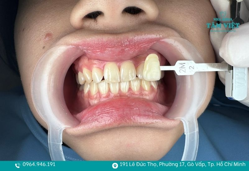 Tẩy trắng răng 1 lần được không? Sự thật bạn cần biết 2 Bạn có thể tẩy trắng răng 1 lần tại nha khoa