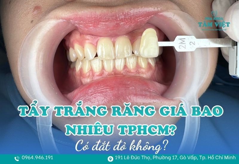 Tẩy trắng răng giá bao nhiêu TPHCM