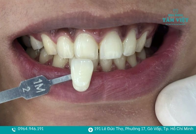 Chi phí tẩy trắng răng còn phụ thuộc vào nhiều yếu tố