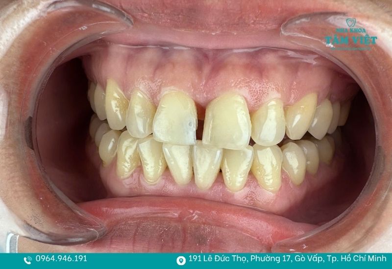 Trám răng giữ được bao lâu? Giải đáp chi tiết từ A - Z 2 Thời gian duy trì miếng trám có thể kéo dài từ 3 - 10 năm