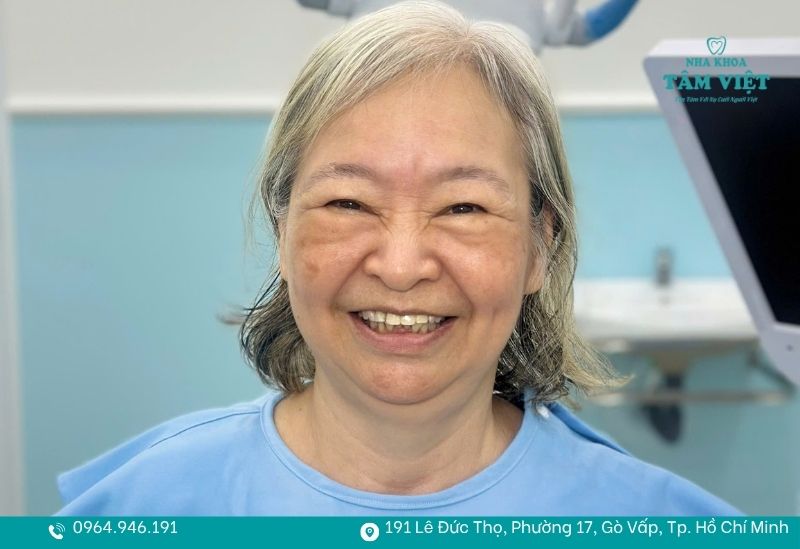 Trám răng giữ được bao lâu? Giải đáp chi tiết từ A - Z 4 Cần giữ vệ sinh răng miệng để kéo dài tuổi thọ của miếng trám