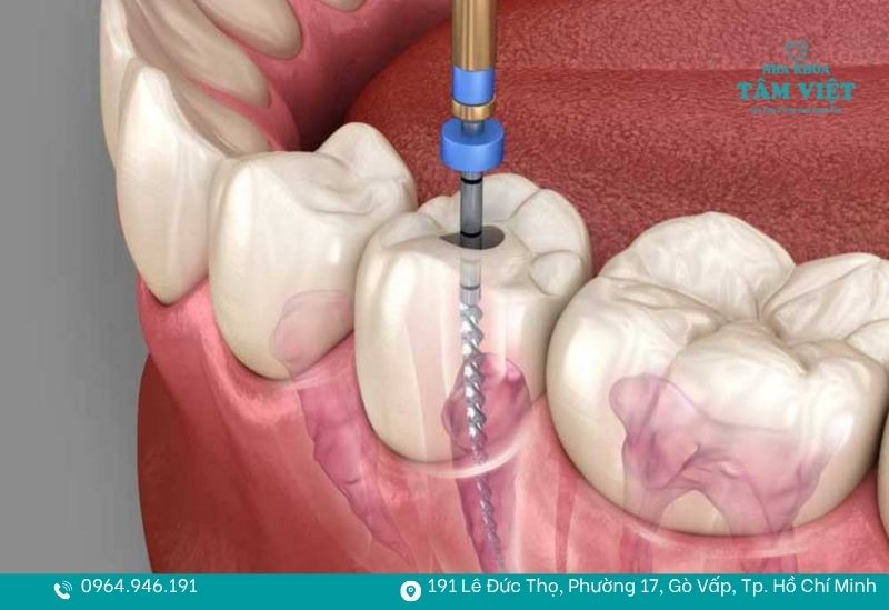 Lấy tuỷ là gì?