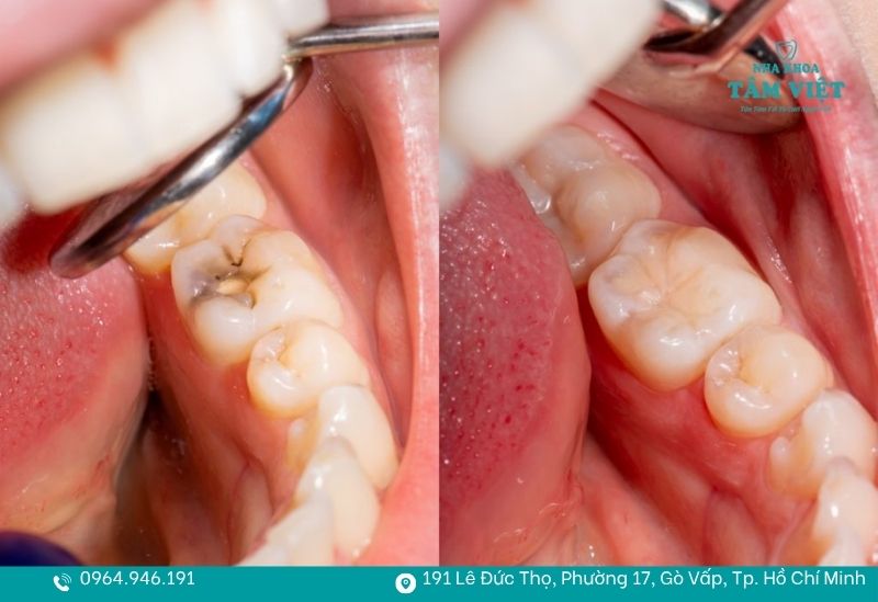 Trám răng sâu an toàn
