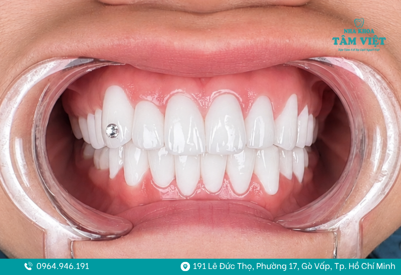 Bí quyết sở hữu nụ cười lấp lánh đính đá răng không khoan 6 Đính đá răng không khoan là gì?