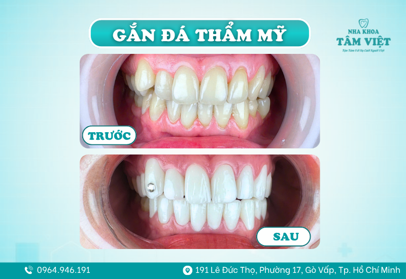 Bí quyết sở hữu nụ cười lấp lánh đính đá răng không khoan 7 Ưu điểm của công nghệ đính đá răng không khoan
