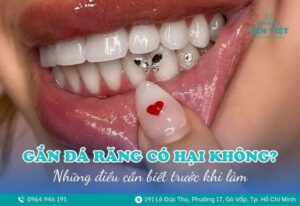 gắn đá răng có hại không 1