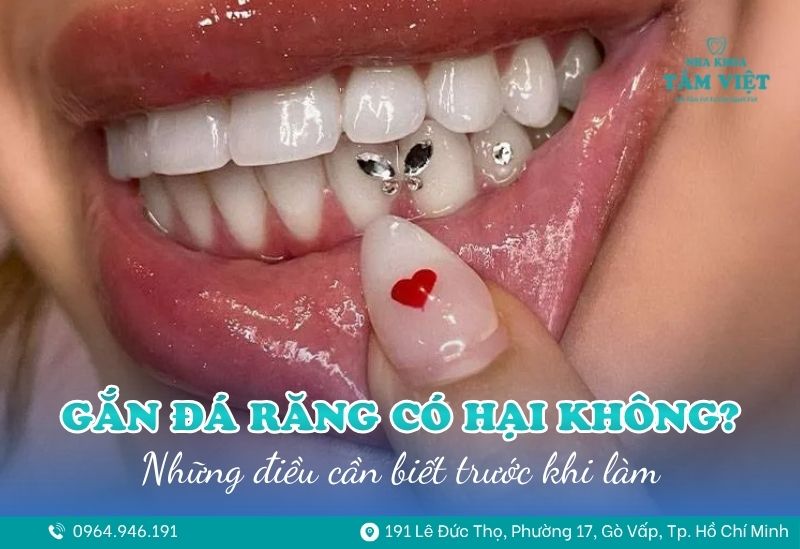 Gắn đá răng có hại không? Những điều cần biết trước khi làm 1 gắn đá răng có hại không 1
