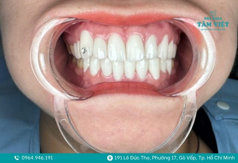 Gắn đá răng có hại không? Những điều cần biết trước khi làm 2 gắn đá răng có hại không 2