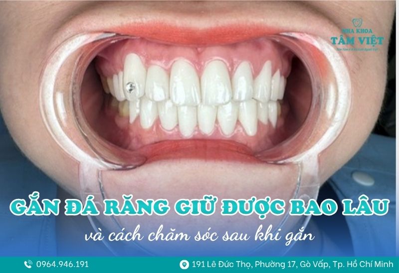 Gắn đá răng giữ được bao lâu và cách chăm sóc sau khi gắn 1 gắn đá răng giữ được bao lâu 1