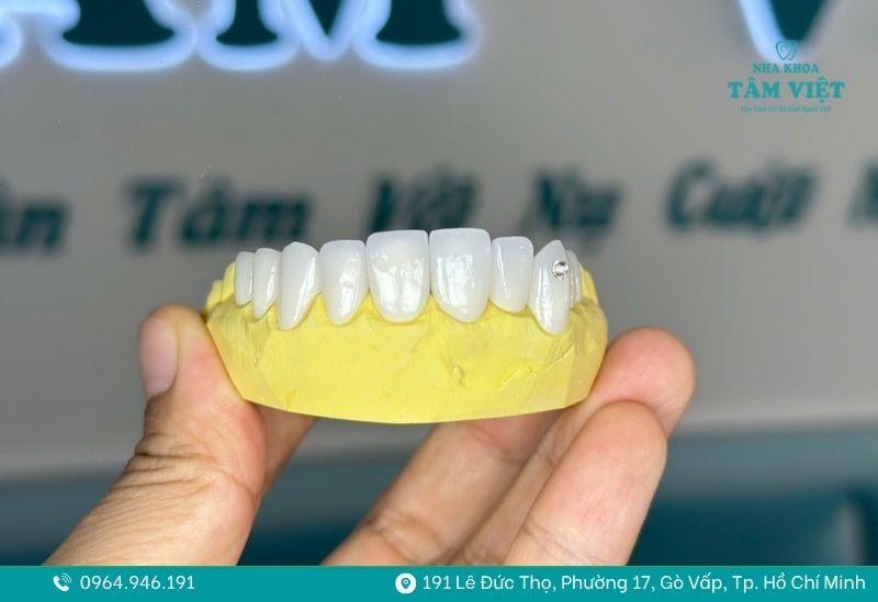 Gắn đá răng giữ được bao lâu và cách chăm sóc sau khi gắn 2 gắn đá răng giữ được bao lâu 2