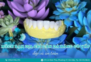 gắn đá răng gò vấp 1