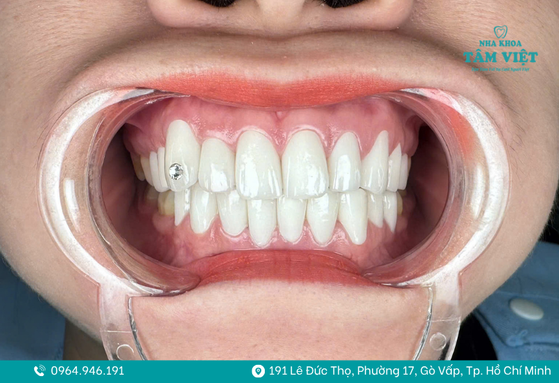 Khuyến mãi nha khoa tháng 7: Đại tiệc răng sứ đón hè 7 Gắn đá răng thẩm mỹ chỉ 199K